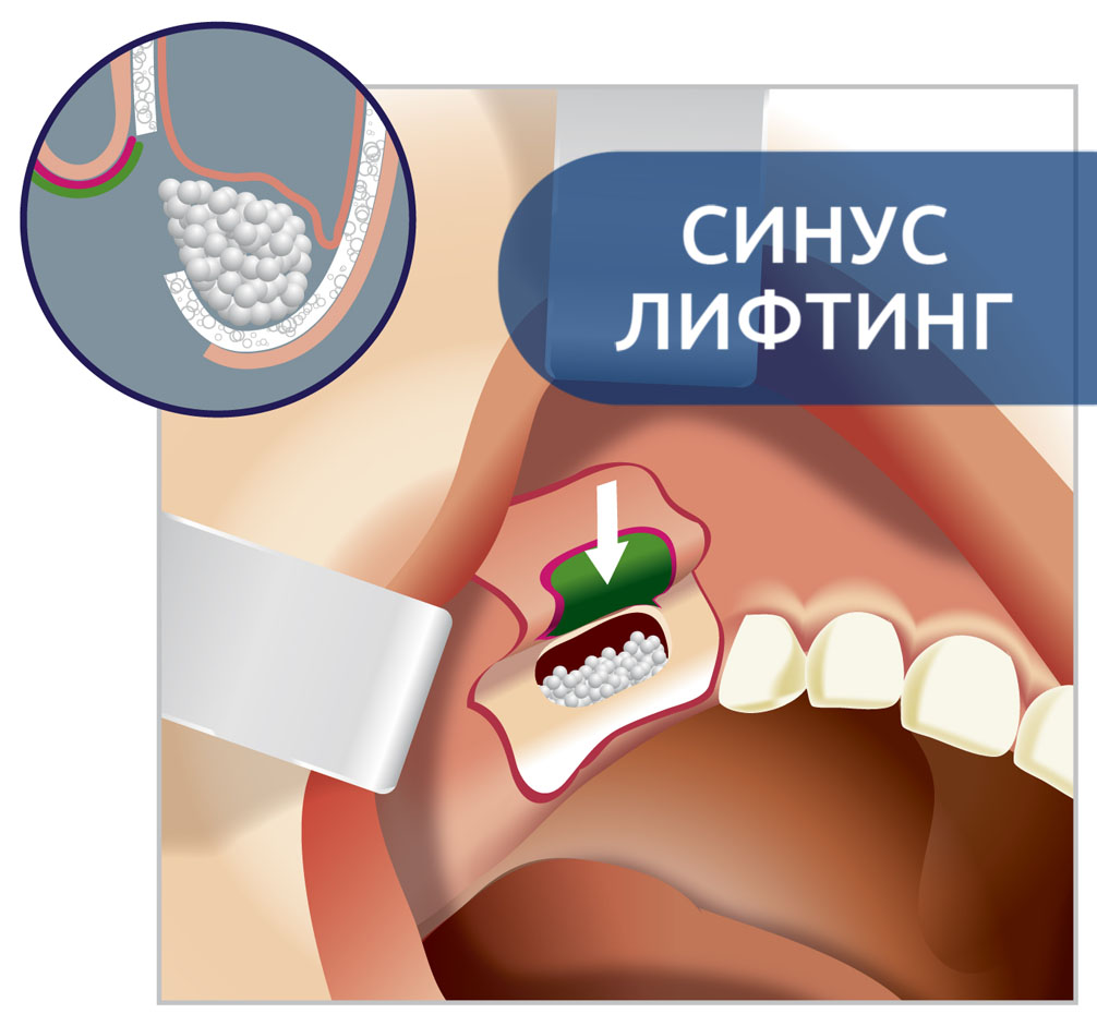 Синус лифтинг в Энгельсе